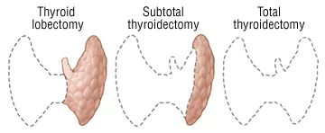 thyroidectomy