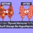 hypothyroidism