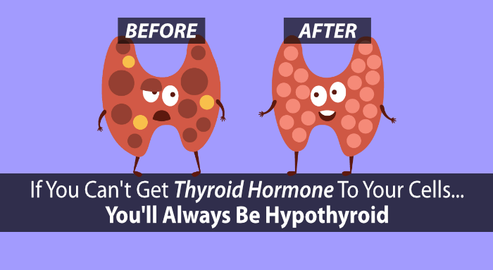 hypothyroidism